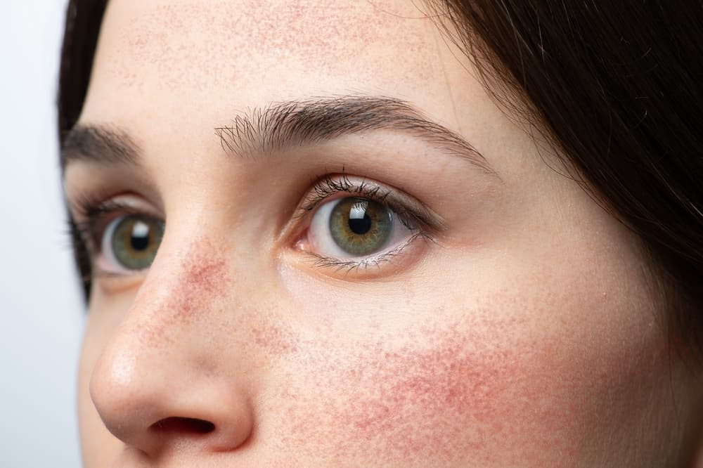 Understanding Facial Blushing: Causes, Impact, and Sympathectomy as a ...